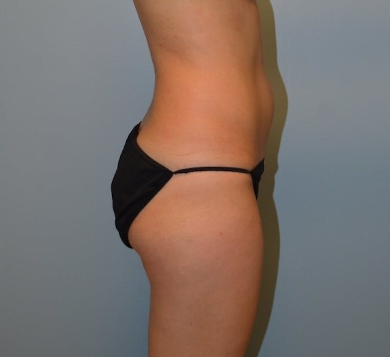 Liposuction Before & After Gallery - Patient 290680 - Image 3