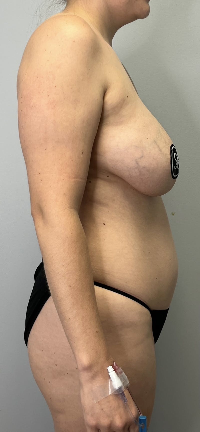 High Definition Mommy Makeover Before & After Gallery - Patient 421466 - Image 5