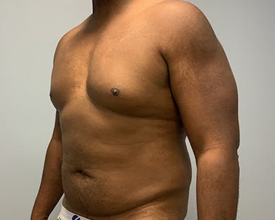 High Definition Men Before & After Gallery - Patient 218446 - Image 1