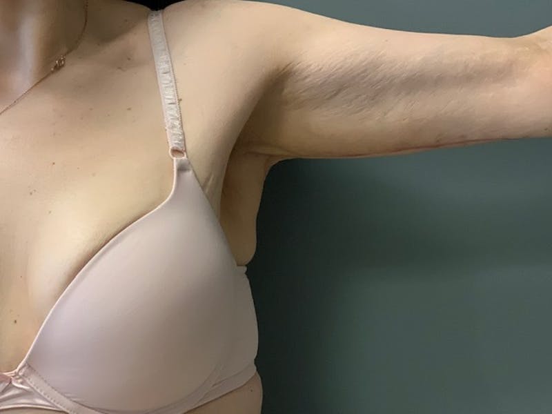 Arm Lift (Scarless Arm Lift) Before & After Gallery - Patient 994810 - Image 4