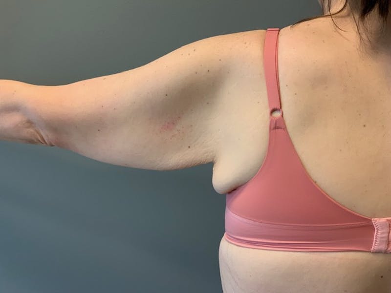 Arm Lift (Scarless Arm Lift) Before & After Gallery - Patient 994810 - Image 5