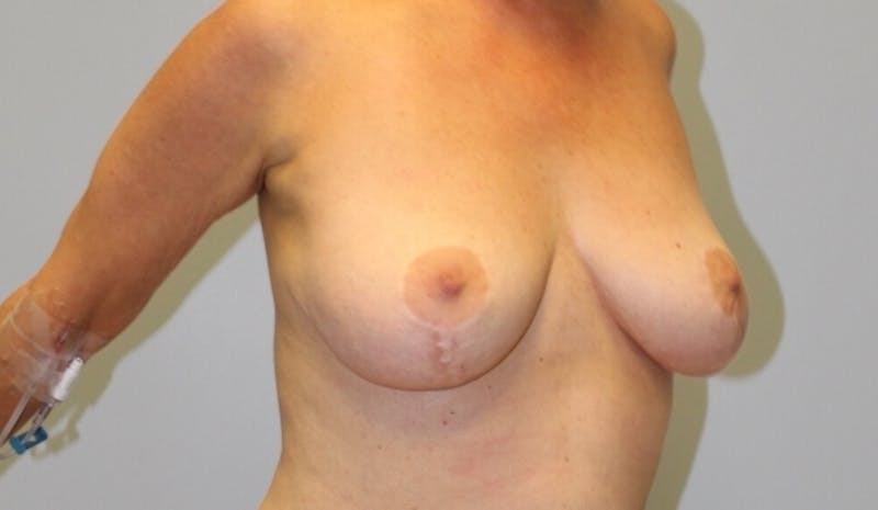 Breast Lift Before & After Gallery - Patient 245356 - Image 1