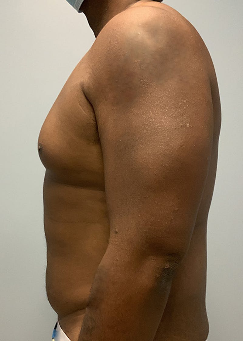 High Definition Men Before & After Gallery - Patient 218446 - Image 3