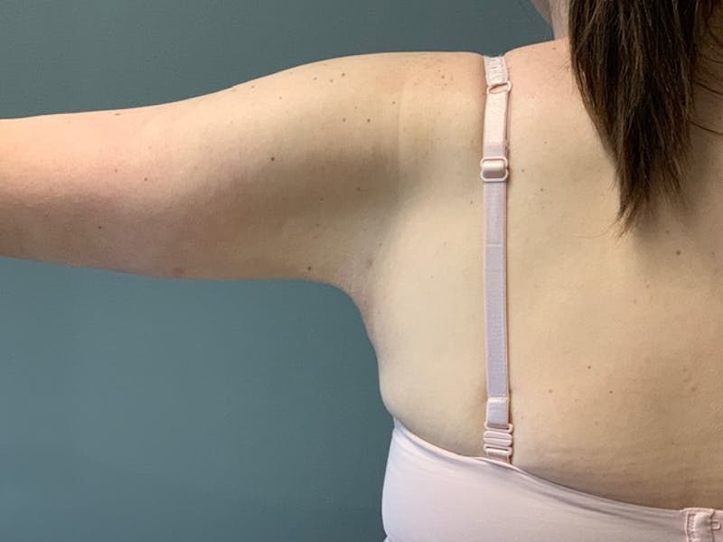 Arm Lift (Scarless Arm Lift) Before & After Gallery - Patient 994810 - Image 6