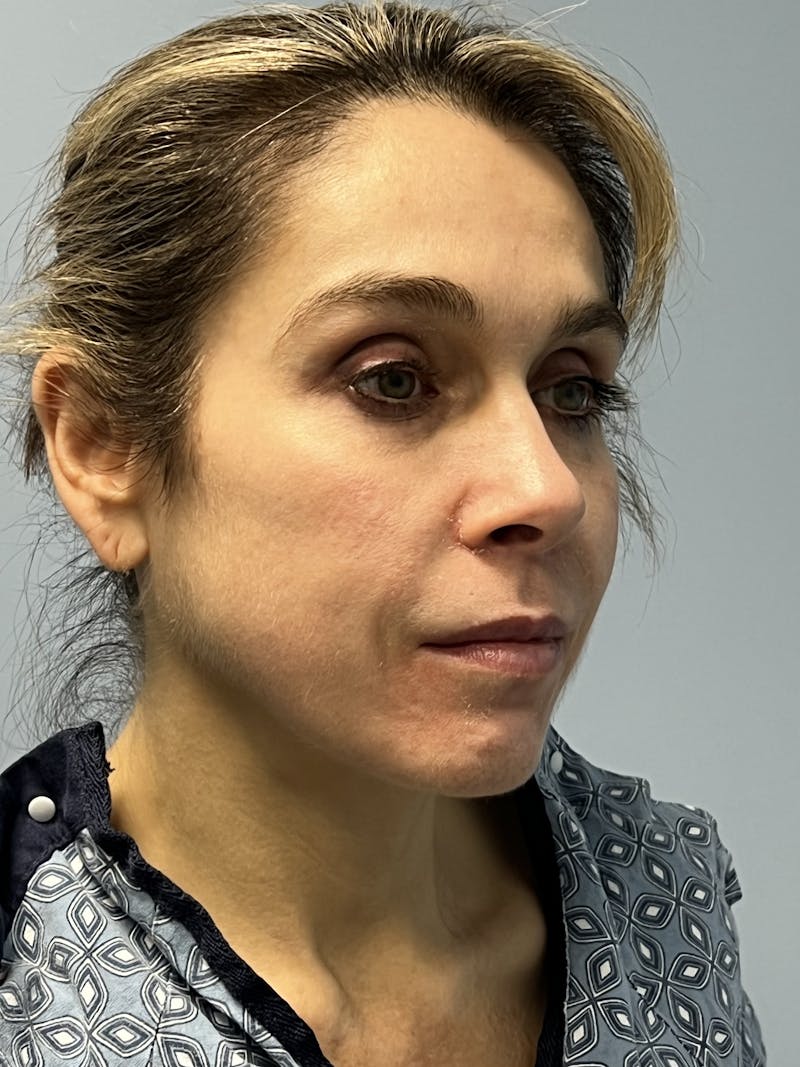Facial Rejuvenation Before & After Gallery - Patient 165474 - Image 3