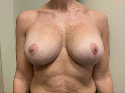 Corrective Breast Procedures Before & After Gallery - Patient 725490 - Image 2