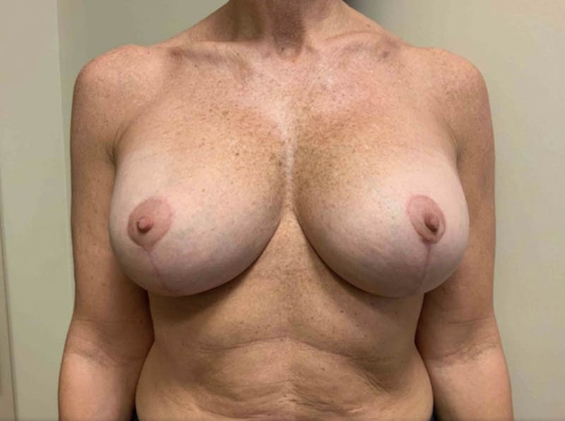 Corrective Breast Procedures Before & After Gallery - Patient 725490 - Image 2