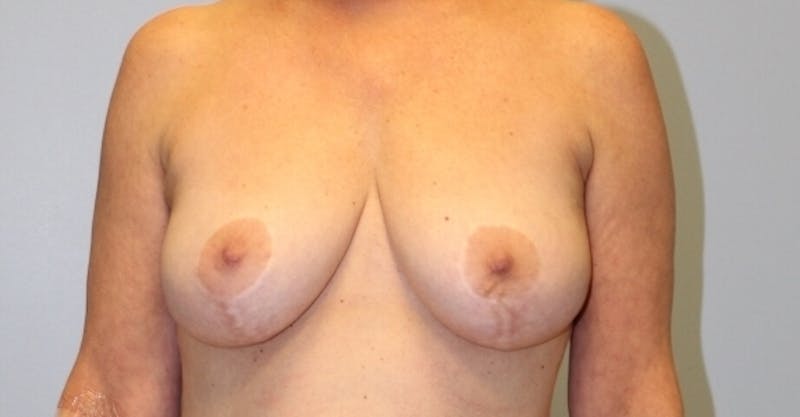 Breast Lift Before & After Gallery - Patient 245356 - Image 3