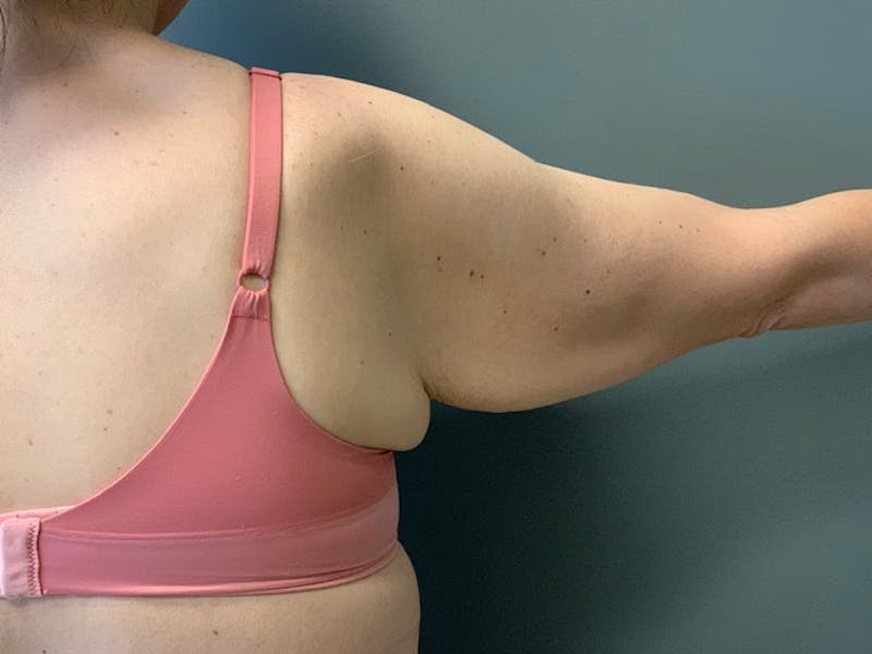 Arm Lift (Scarless Arm Lift) Before & After Gallery - Patient 994810 - Image 7