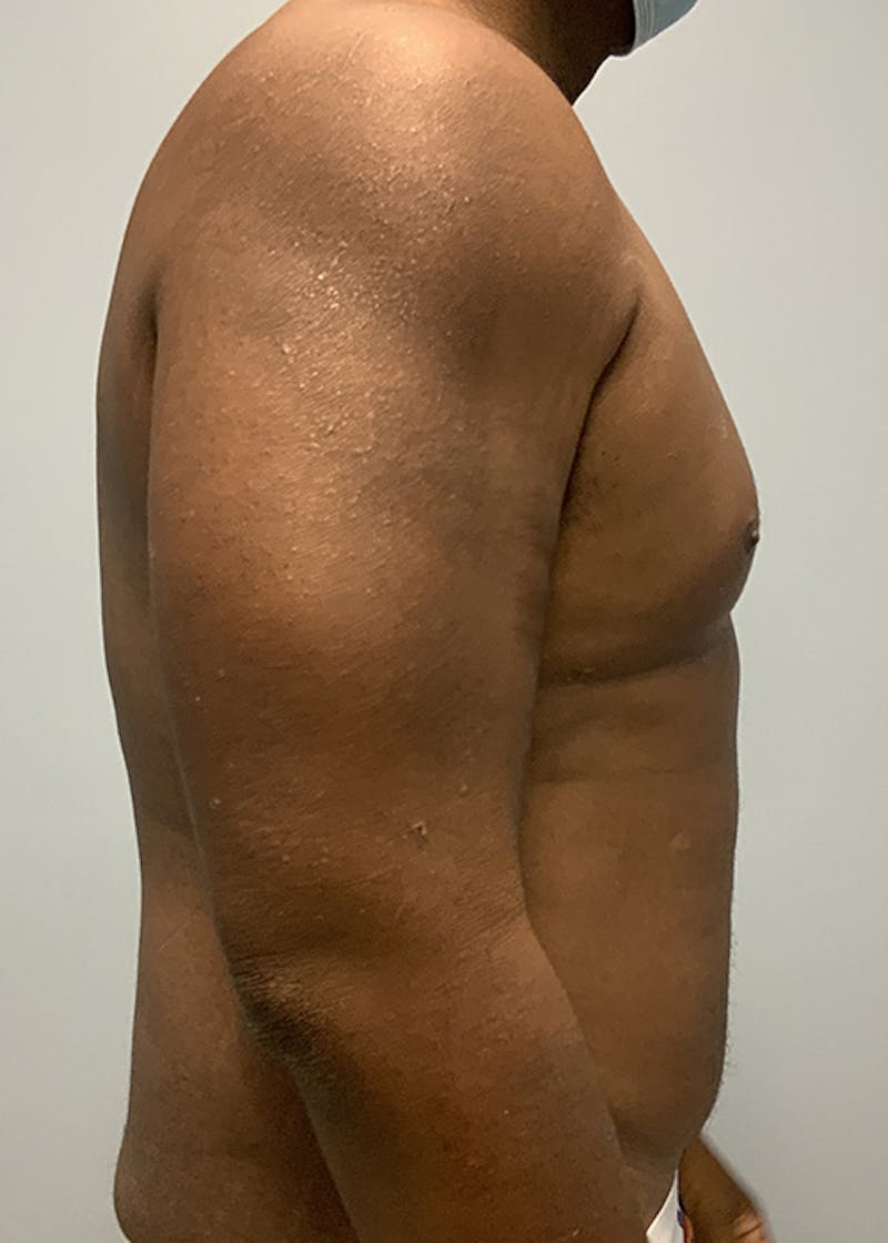 High Definition Men Before & After Gallery - Patient 218446 - Image 5