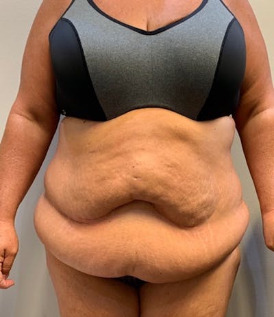 Tummy Tuck Before & After Gallery - Patient 150872 - Image 1