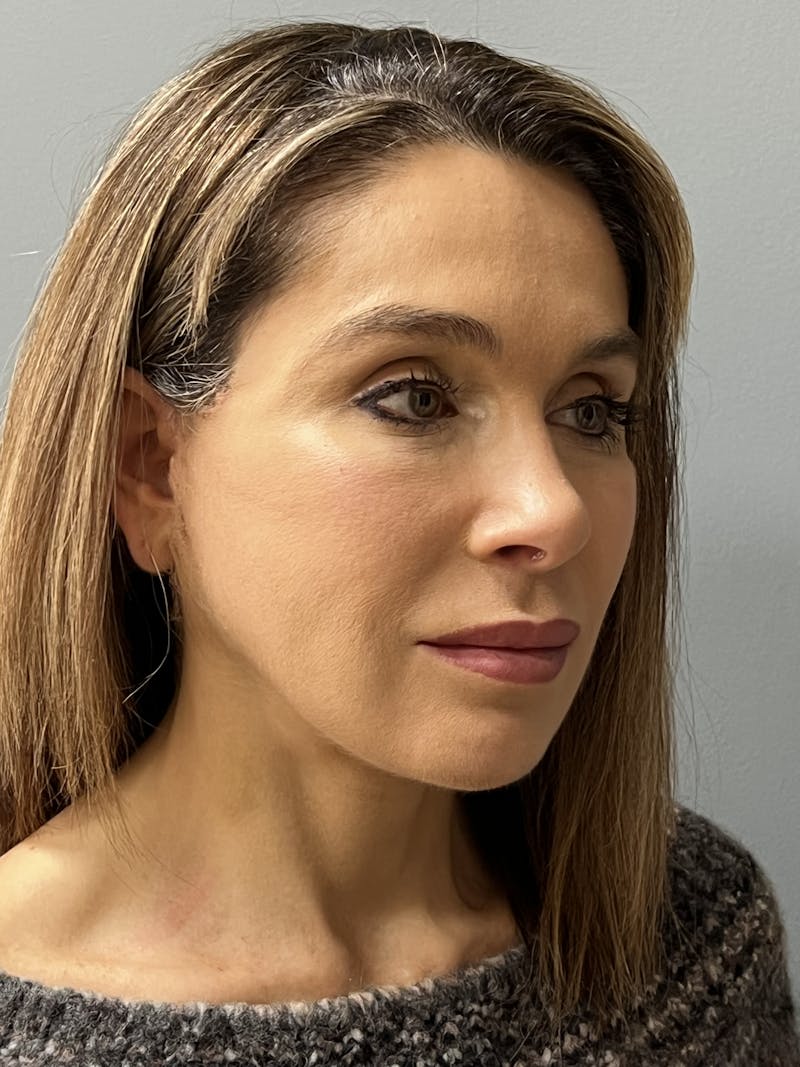 Facial Rejuvenation Before & After Gallery - Patient 165474 - Image 4