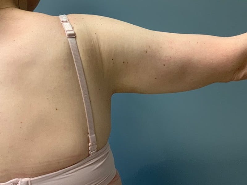 Arm Lift (Scarless Arm Lift) Before & After Gallery - Patient 994810 - Image 8
