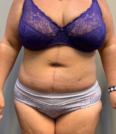Tummy Tuck Before & After Gallery - Patient 150872 - Image 2