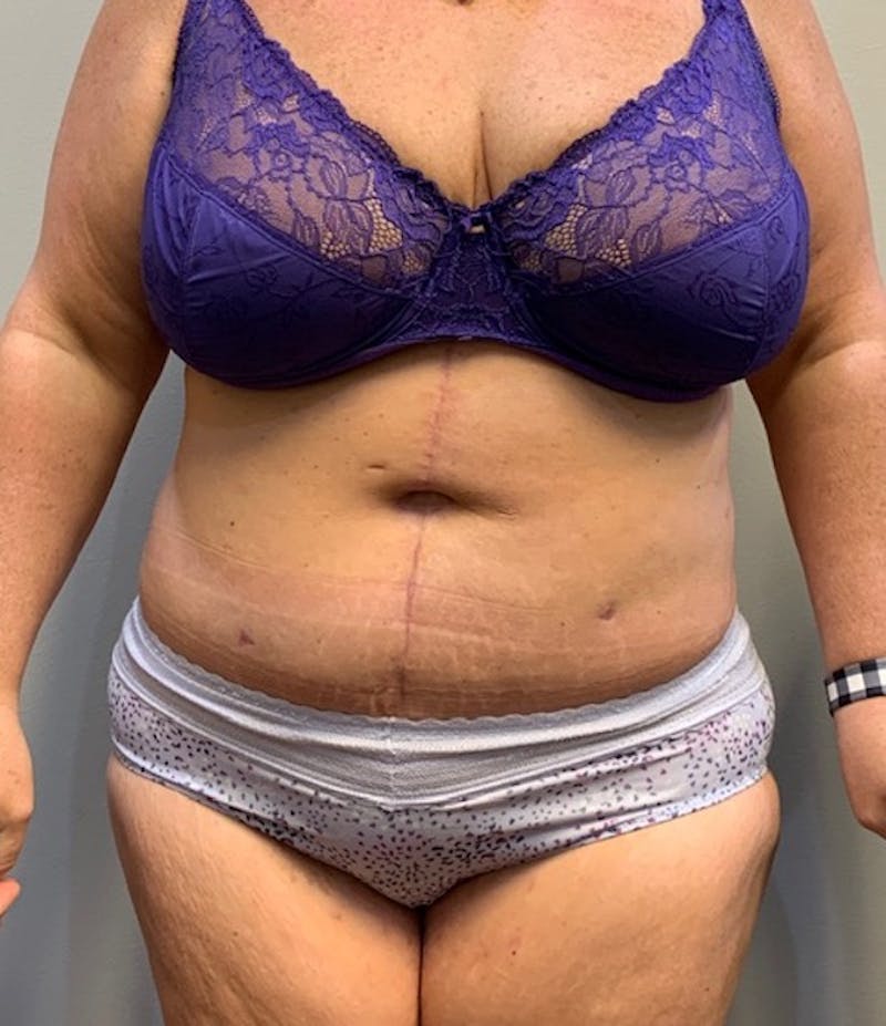 Tummy Tuck Before & After Gallery - Patient 150872 - Image 2