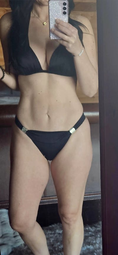 High Definition Mommy Makeover Before & After Gallery - Patient 111947 - Image 2