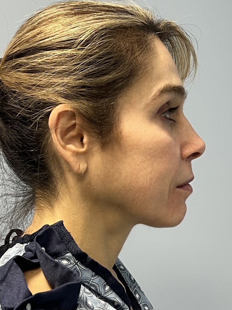 Facial Rejuvenation Before & After Gallery - Patient 165474 - Image 5