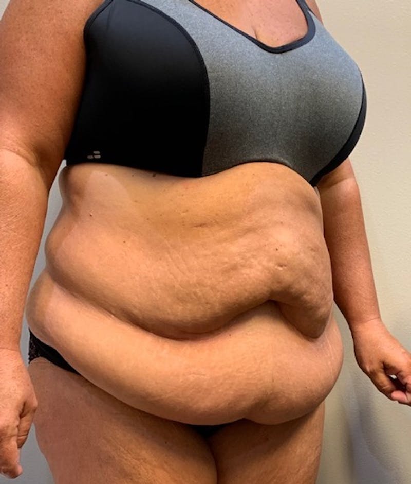 Tummy Tuck Before & After Gallery - Patient 150872 - Image 3