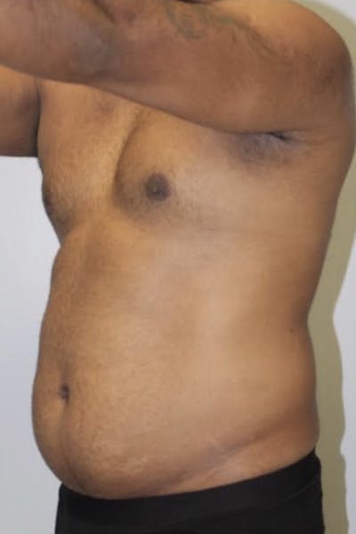 High Definition Men Before & After Gallery - Patient 262435 - Image 1