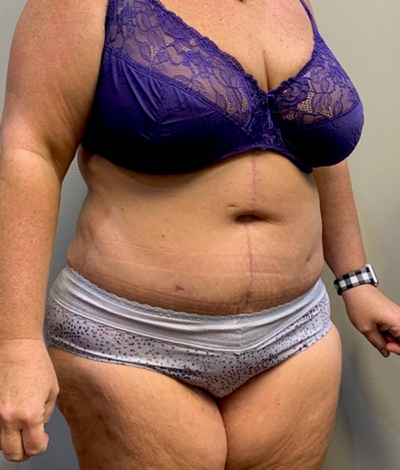 Tummy Tuck Before & After Gallery - Patient 150872 - Image 4