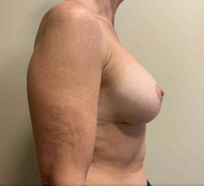 Corrective Breast Procedures Before & After Gallery - Patient 725490 - Image 6