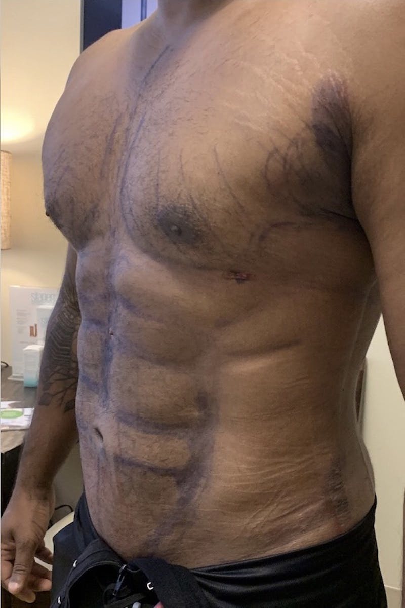 High Definition Men Before & After Gallery - Patient 262435 - Image 2