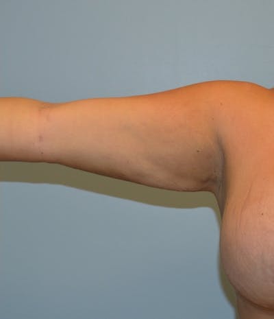 Arm Lift (Scarless Arm Lift) Before & After Gallery - Patient 359137 - Image 2
