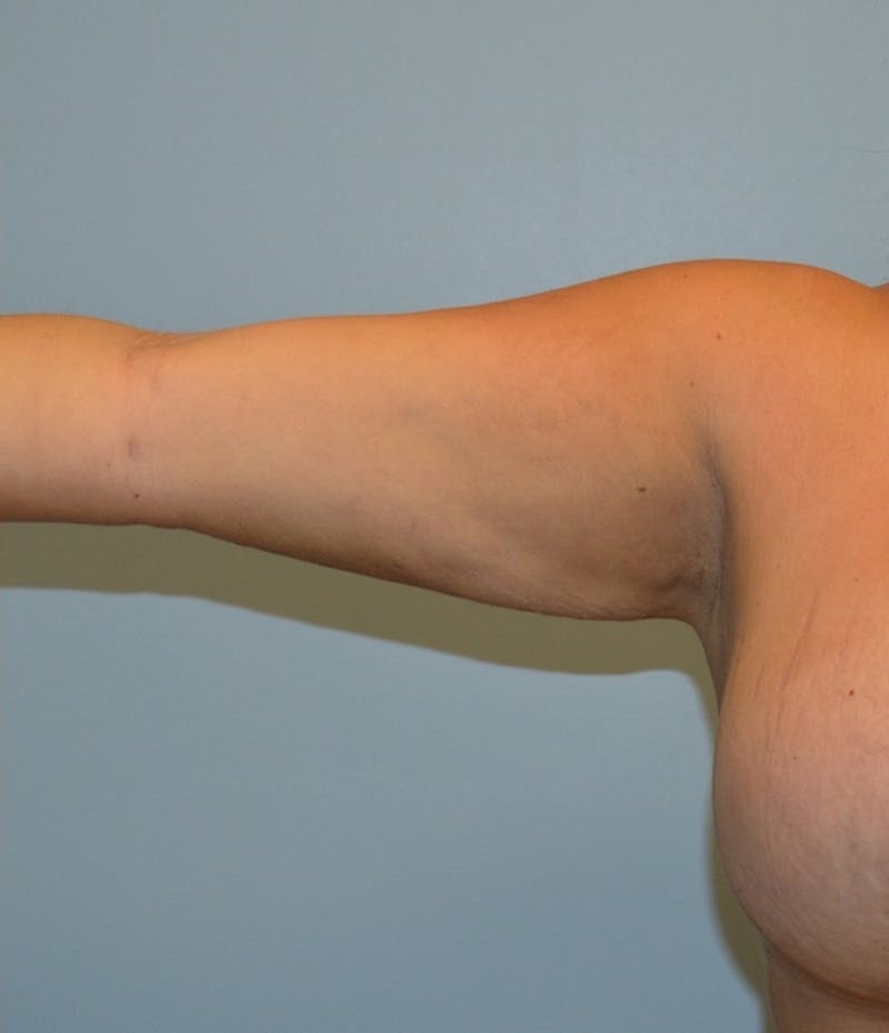 Arm Lift (Scarless Arm Lift) Before & After Gallery - Patient 359137 - Image 2