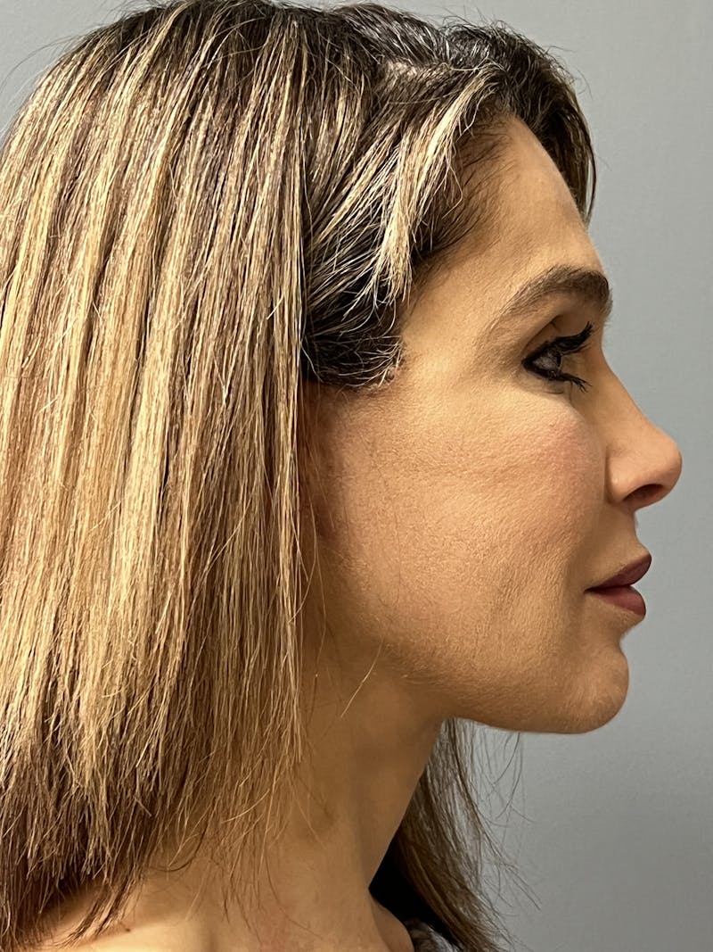 Facial Rejuvenation Before & After Gallery - Patient 165474 - Image 6