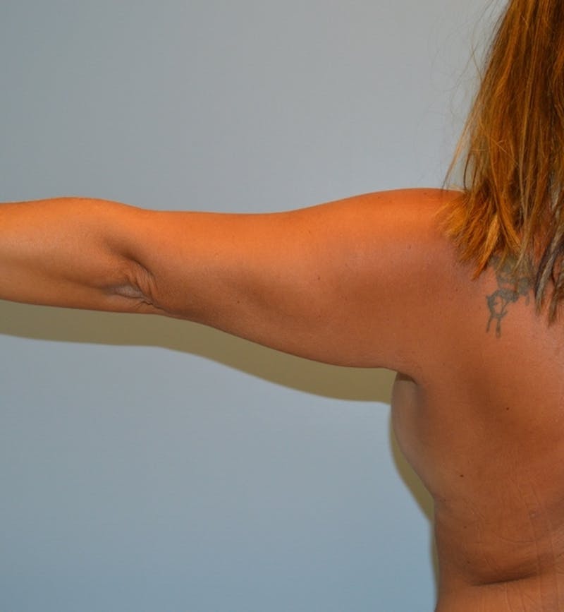 Arm Lift (Scarless Arm Lift) Before & After Gallery - Patient 359137 - Image 3