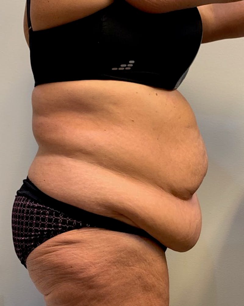 Tummy Tuck Before & After Gallery - Patient 150872 - Image 5