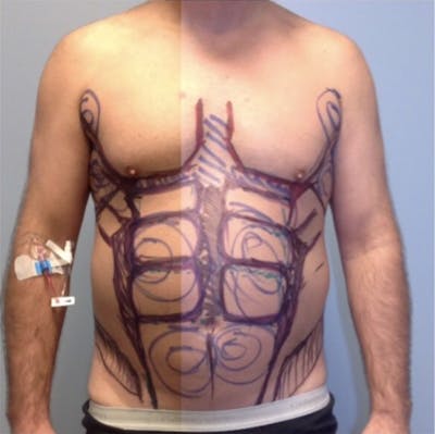 High Definition Men Before & After Gallery - Patient 410538 - Image 1