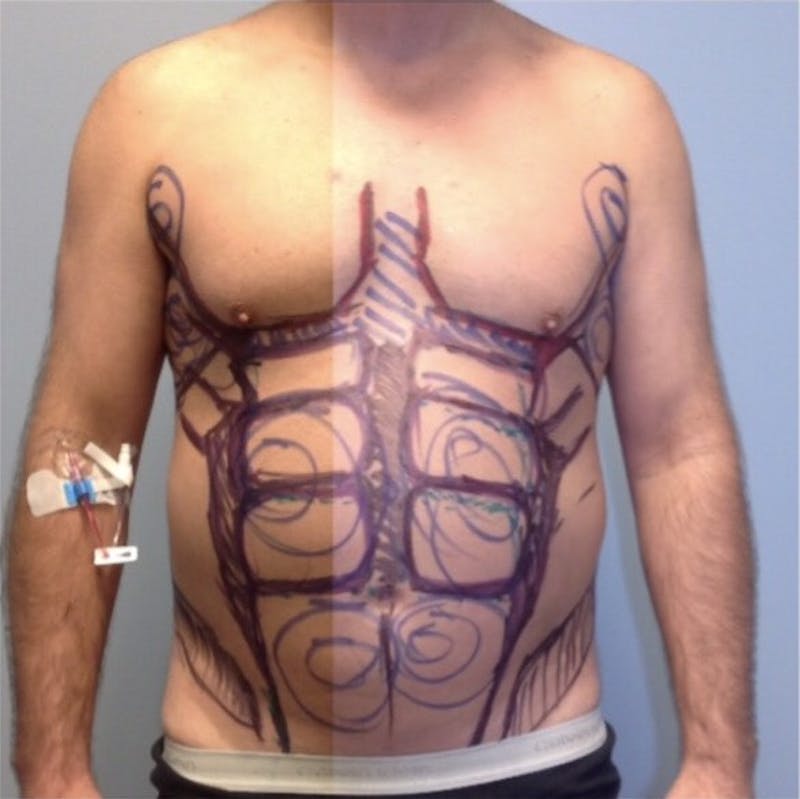 High Definition Men Before & After Gallery - Patient 410538 - Image 1