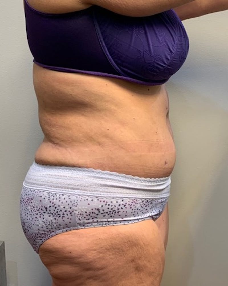 Tummy Tuck Before & After Gallery - Patient 150872 - Image 6