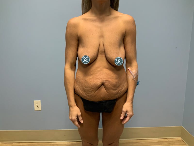 High Definition Mommy Makeover Before & After Gallery - Patient 376105 - Image 1