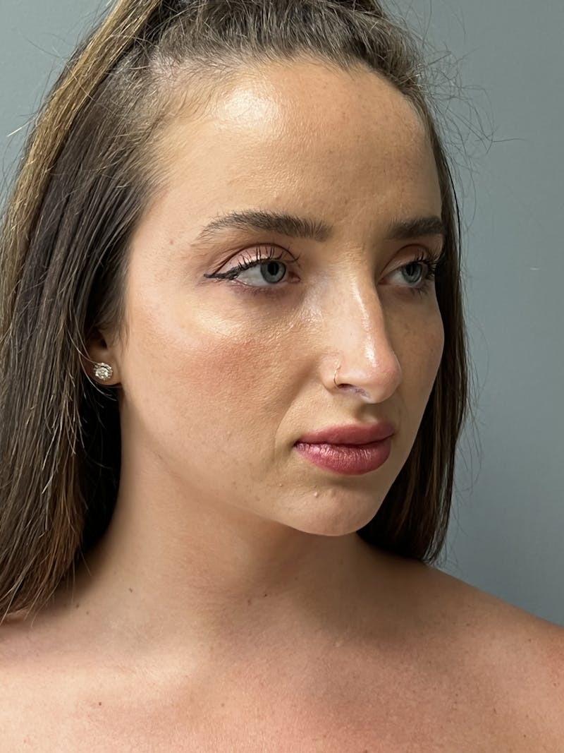 Deep Plane Neck Lift Before & After Gallery - Patient 332328 - Image 3