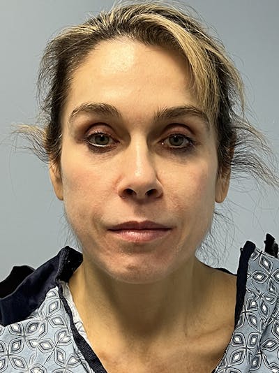 Facial Rejuvenation Before & After Gallery - Patient 264077 - Image 1