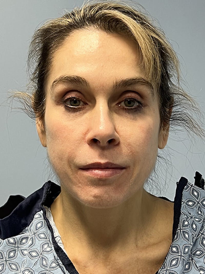 Facial Rejuvenation Before & After Gallery - Patient 264077 - Image 1