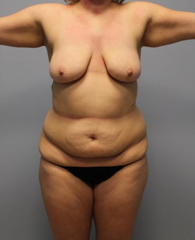 Tummy Tuck Before & After Gallery - Patient 291555 - Image 1