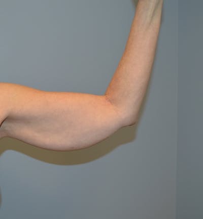 Arm Lift (Scarless Arm Lift) Before & After Gallery - Patient 405899 - Image 1