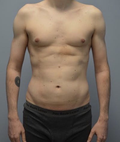 High Definition Men Before & After Gallery - Patient 304271 - Image 1