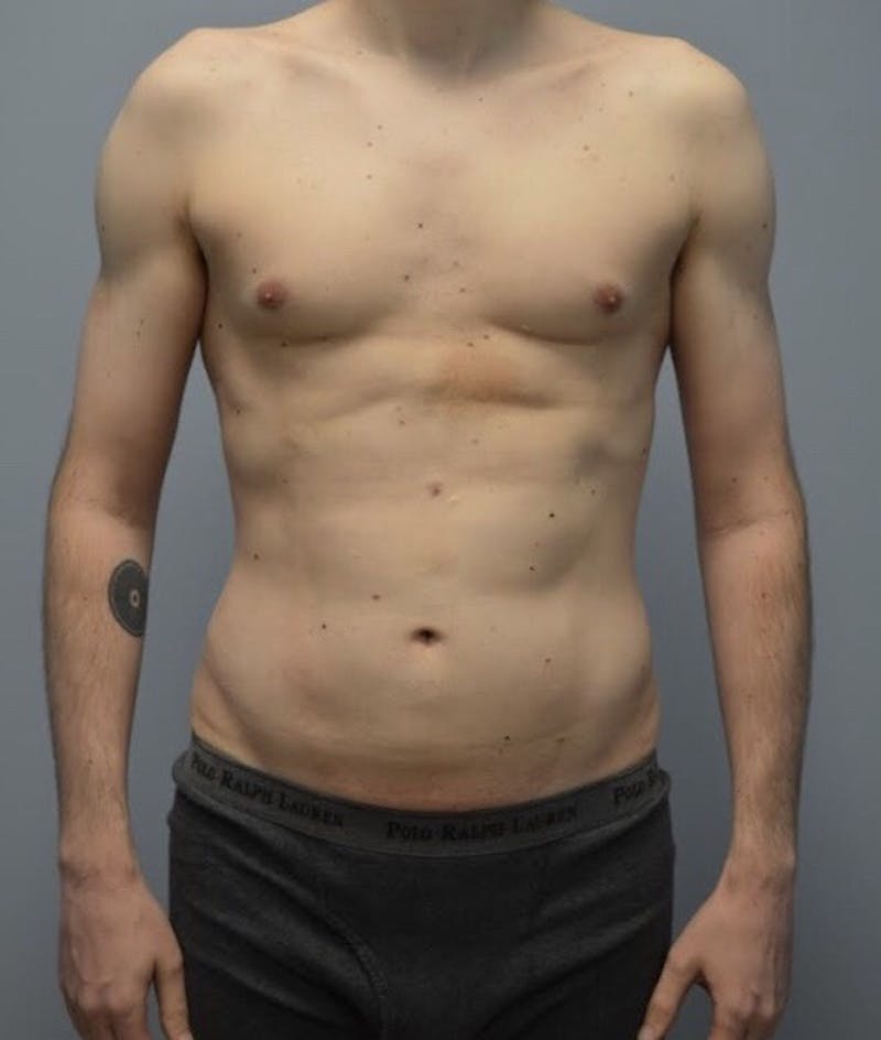 High Definition Men Before & After Gallery - Patient 304271 - Image 1