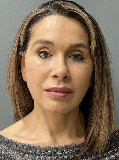 Facial Rejuvenation Before & After Gallery - Patient 264077 - Image 2