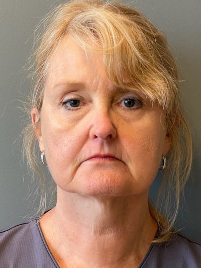 Deep Plane Facelift Before & After Gallery - Patient 175323 - Image 1