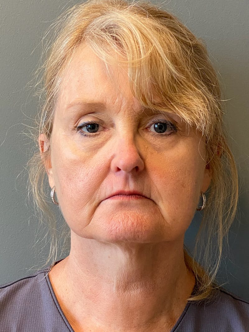 Deep Plane Facelift Before & After Gallery - Patient 175323 - Image 1