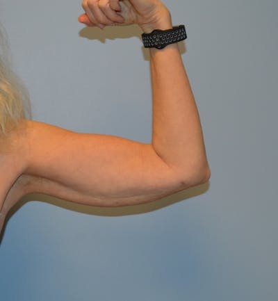 Arm Lift (Scarless Arm Lift) Before & After Gallery - Patient 405899 - Image 2