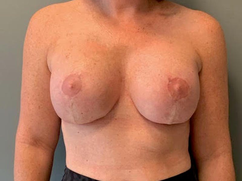 Breast Lift Before & After Gallery - Patient 160014 - Image 2