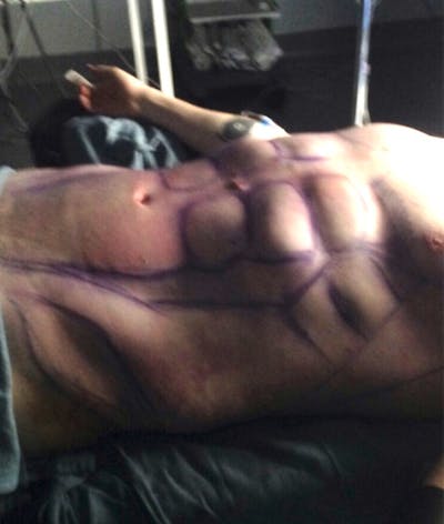 High Definition Men Before & After Gallery - Patient 304271 - Image 2