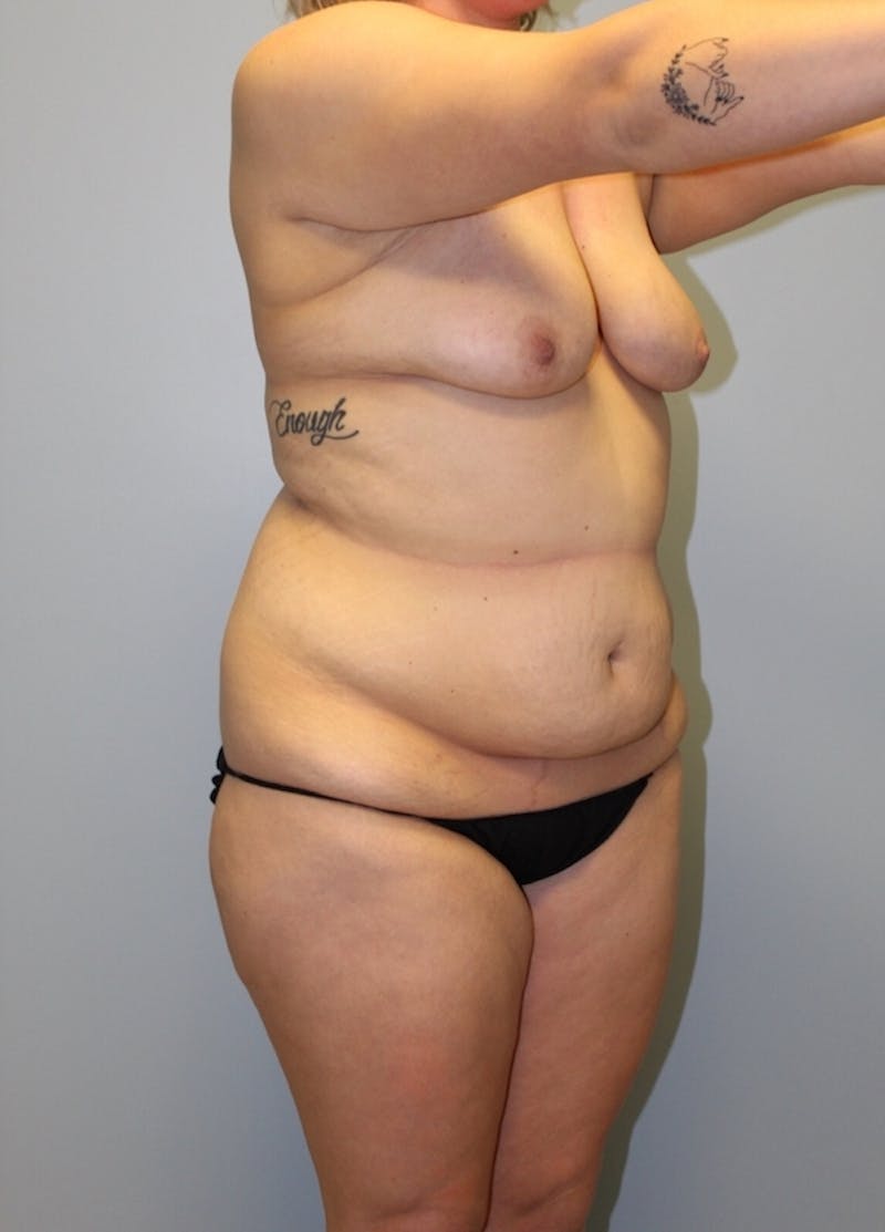 Tummy Tuck Before & After Gallery - Patient 291555 - Image 3