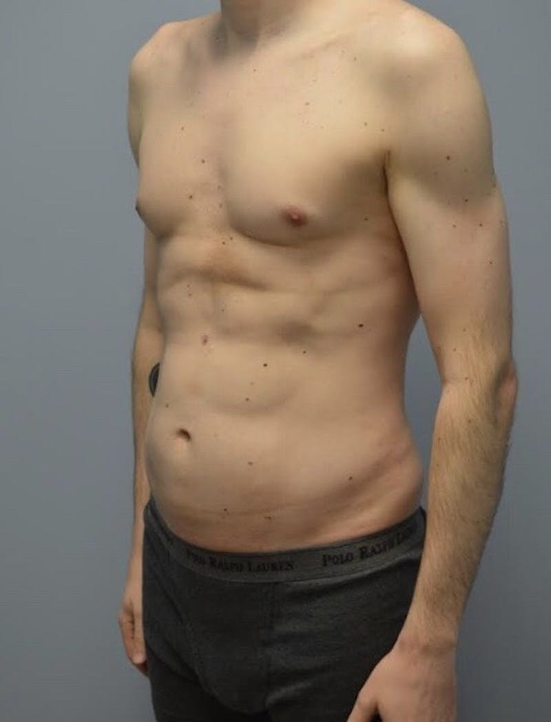 High Definition Men Before & After Gallery - Patient 304271 - Image 3
